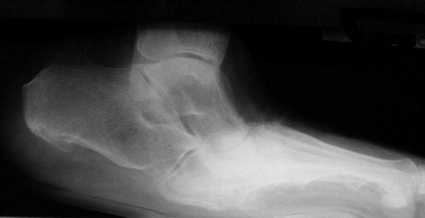 CHARCOT: DIAGNOSTIEK RX lateraal :