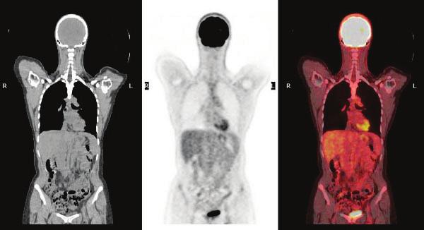 Bekijk het youtube-filmpje onder nevenstaande link: link naar filmpje 1). m) Leg uit wat het verband is tussen een gewone röntgenopname en een CT-scan.