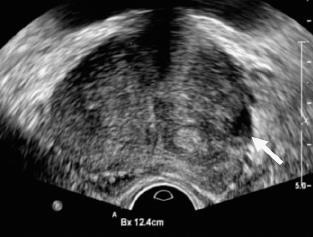 3. Transrectale echografie Bepaling prostaatvolume interpreteren PSA (PSA densiteit) Detecteren verdachte zone