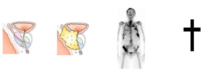 Evolutie prostaatkanker Klein gelokaliseerd Lokaal geavanceerd Uitgezaaid Overlijden 1) Niet altijd progressief