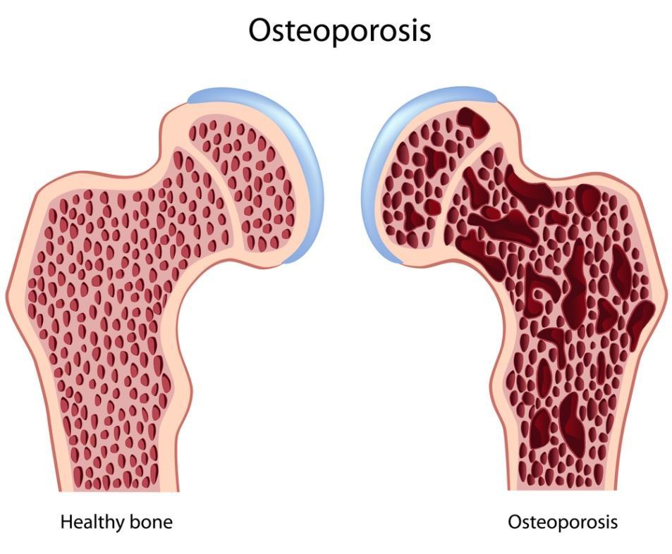 Maar bijwerkingen Op lange termijn: osteoporose 2010 2014