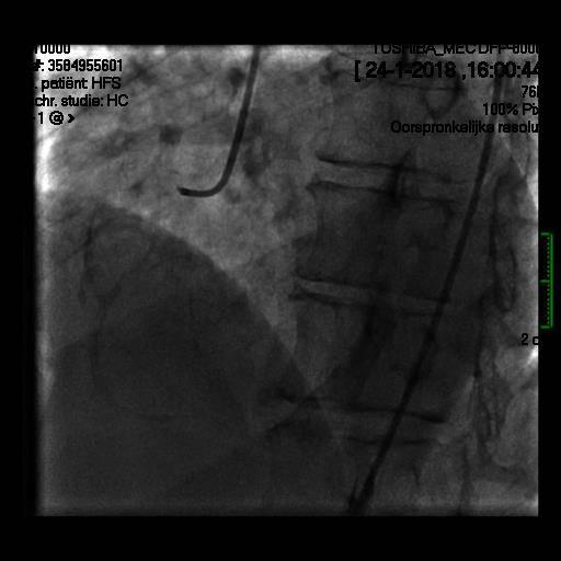 Coronairangiografie