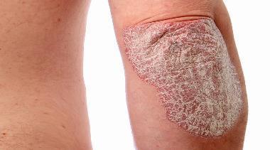 PSORIASIS Psoriasis is een chronische huidziekte die wordt gekenmerkt door dikke rode