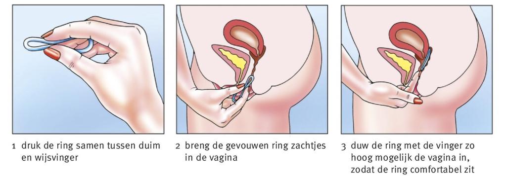 Extra basisstof 9 Andere manieren van geboorteregeling NuvaRing = bevat hormonen net als de pil, je doet de ring in de vagina Prikpil = vrouw krijgt om de 3 maanden een prik met