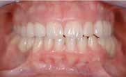 Het feit dat bij circa 5 % van de blanke Europese bevolking ontbrekende definitieve tanden worden aangetroffen, impliceert dat elke tandarts hiermee geconfronteerd wordt.