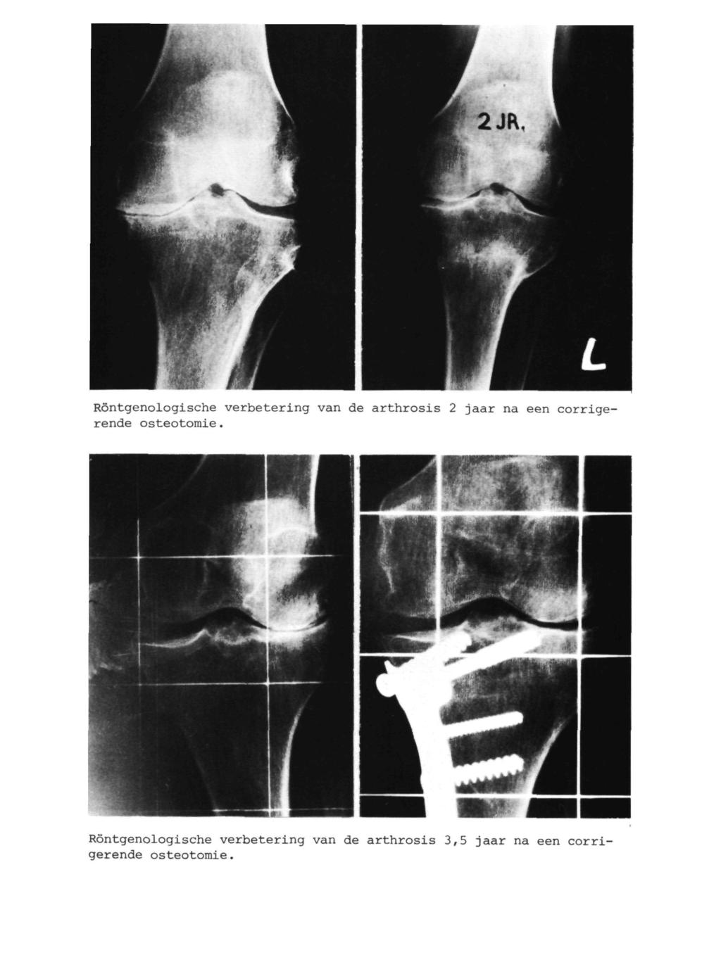 Röntgenologische verbetering van de arthrosis 2 jaar na een corrigerende Osteotomie.