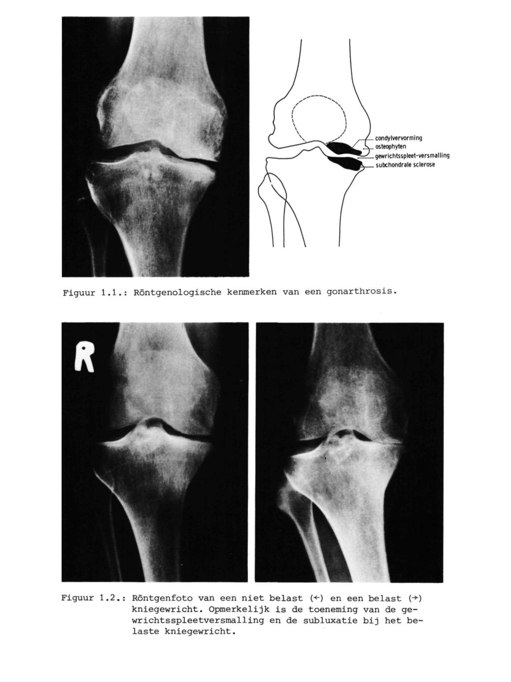 condylvervorming osteophylen gewrichtsspleet-versmalling subchondrale sclerose Figuur 1.1.: Röntgenologische kenmerken van een gonarthrosis. Figuur 1.2.