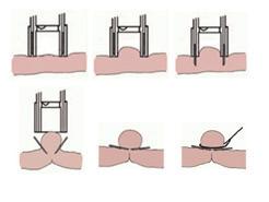 eftr techniek Bij de eftr techniek (voluit: endoscopische Full Thickness Resectie) wordt de poliep inclusief de darmwand eronder verwijderd.