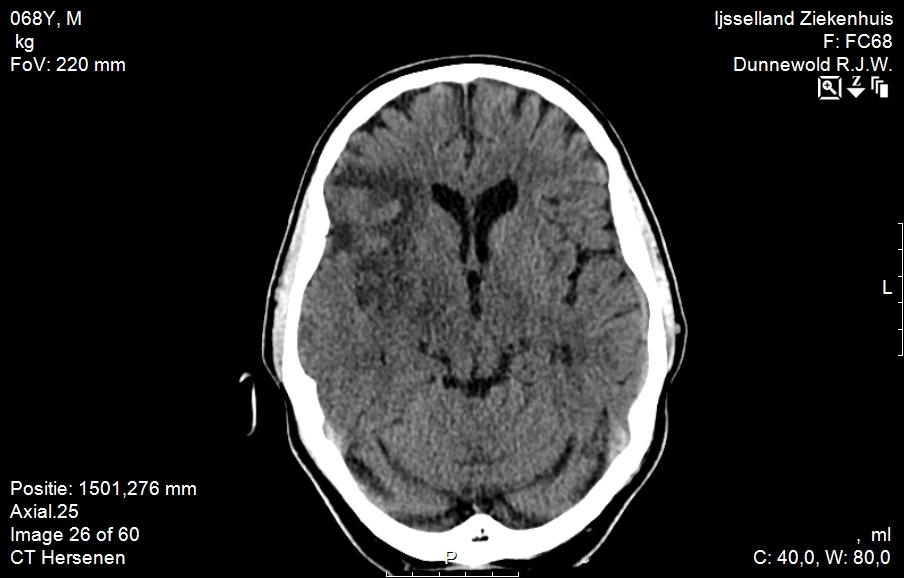 Casus D 68 jarige man Kon plotseling niet meer opstaan Er bleek sprake van een hemibeeld links met een centrale facialis parese links CT-scan: groot infarct in media gebied rechts met deels