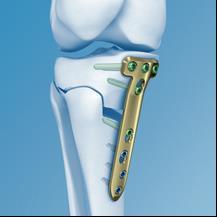 Inleiding Deze brochure biedt u de nodige informatie over de heelkundige behandeling van de kanteloperatie (osteotomie) van de knie.