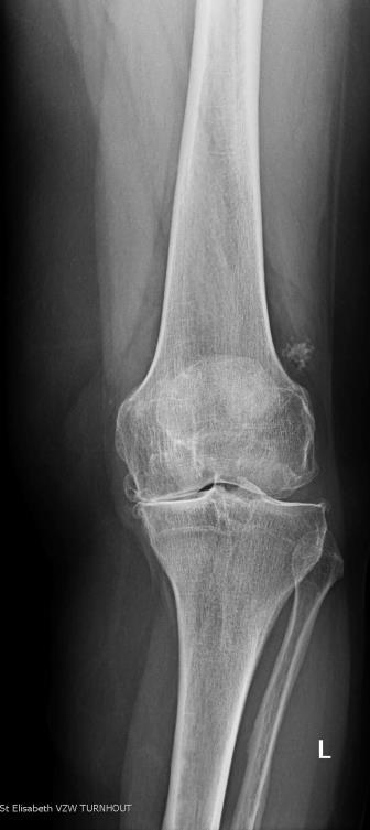 Informatie over het ziektebeeld Het doel van een valgiserende osteotomie (kanteloperatie) is de druk op de binnenkant van de knie (het mediaal compartiment) te verminderen.