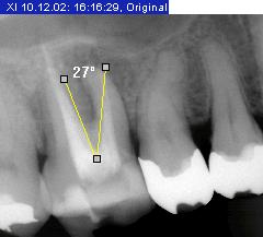 Sirona Dental Systems GmbH 3 Bediening 3.7 Analysehulpmiddelen 4. Bevestig deze plaats met een klik op de linker muistoets. 5. Trek met de muiscursor het tweede been naar de hoekmeting.