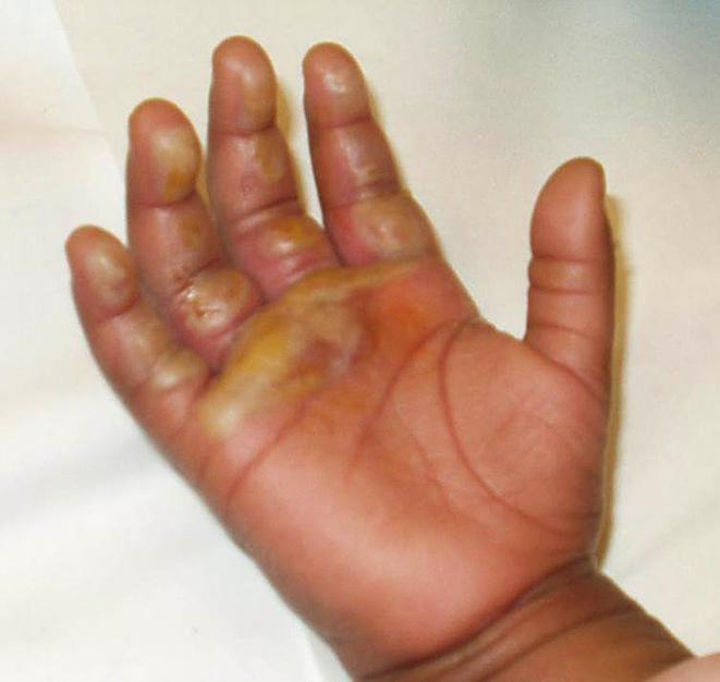 KLINISCHE PRAKTIJK FIGUUR 2 Patiënt B met tweedegraads brandwonden op de hand en op de voetzool met een opengesprongen blaar en lokale roodheid, passend bij secundaire infectie.