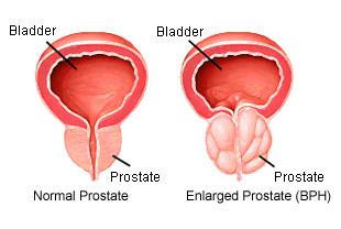 BPH Pathofysiologie l De normale prostaat bevat stromaweefsel met gladde spiercellen (onder alfa-adrenerge controle) en epitheliaal weefsel dat de klier vormt (indirect afankelijk van testosteron) in