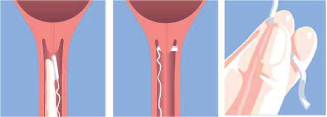 c) Balloncatheter met Prepidil gel Wanneer een balloncatheter alleen onvoldoende is, spuit je arts langs deze catheter een gel in die medicatie bevat om de baarmoederhals verder uit te rijpen.