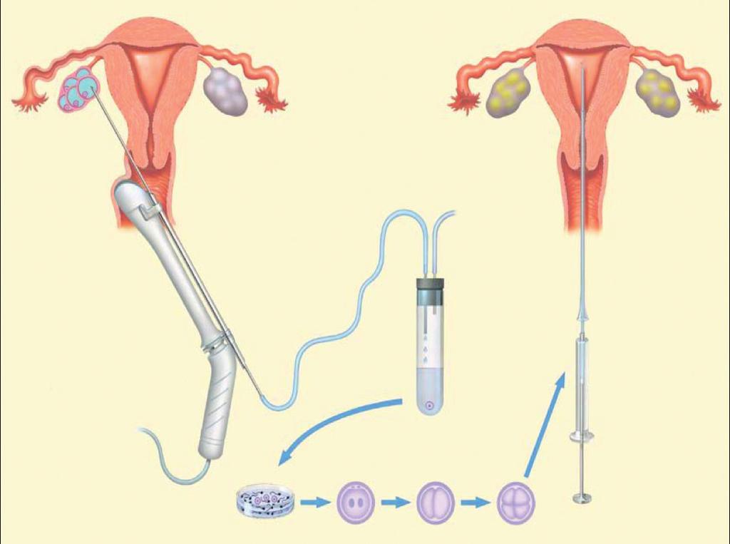 MEDISCH BEGELEIDE VOORTPLANTING / 9 Het aanprikken van eierstokken onder echografische geleide Bewerking van het zaad (sperma) De ochtend van de eicelpunctie wordt het zaad in het laboratorium