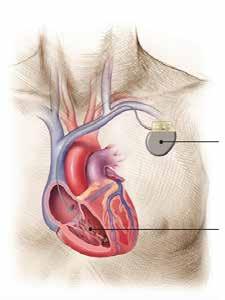 Een pacemaker is een klein toestel dat de werking van de zieke sinusknoop en/of AV-knoop overneemt, waardoor het hart weer in het normale tempo en ritme pompt.
