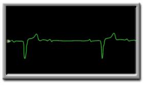 Frequentie Bradycardie - kliniek - >60-70 /min: meestal geen probleem 50-60 /min: risico decompensatio cordis/ failure to