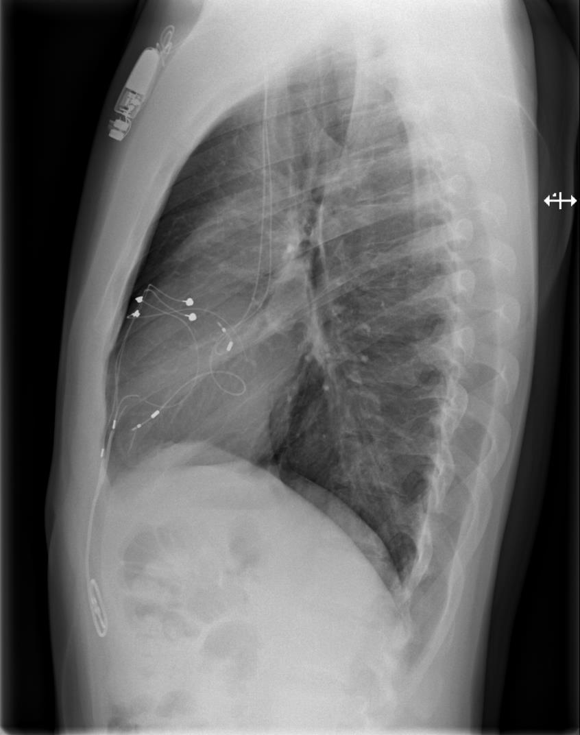 3 Endocardiale PM 9