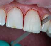 Deze gaatjes werden geboord in het midden van de snijrand van elke tand, halverwege tussen de distale en de mesiale randen (afb. 4).