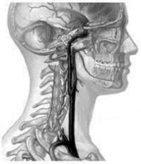 Uw vaatchirurg heeft ontdekt dat u een ernstige vernauwing hebt aan een of beide halsslagaders. Dit is het gevolg van verkalking in de slagader (atherosclerose).