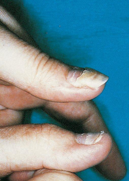 Behandeling en bijwerkingen: chemotherapie Wat de nagels en de haren ondergaan hebben Is ook de spieren aangedaan!