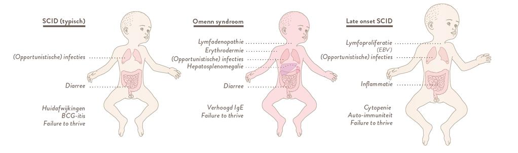 Severe Combined Immunodeficiency (SCID) incidentie - pathofysiologie meest ernstige primaire immuundeficiëntie (PID) afwezigheid van functionele T cellen + afwezigheid/dysfunctie B cellen Infecties