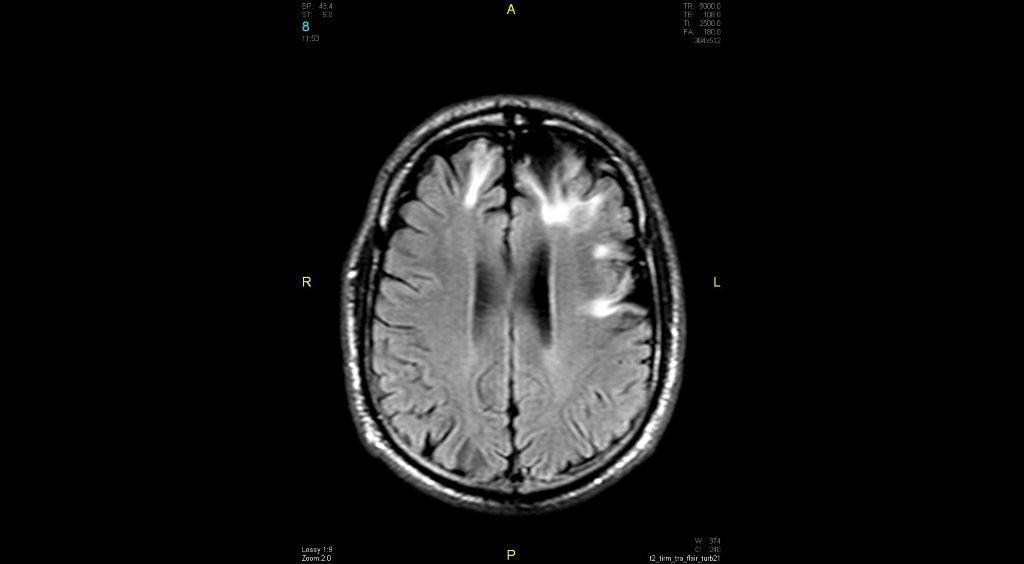 Frontobasaal beiderzijds een aanzienlijke posttraumatische laesie reikend van de cortex tot aan de