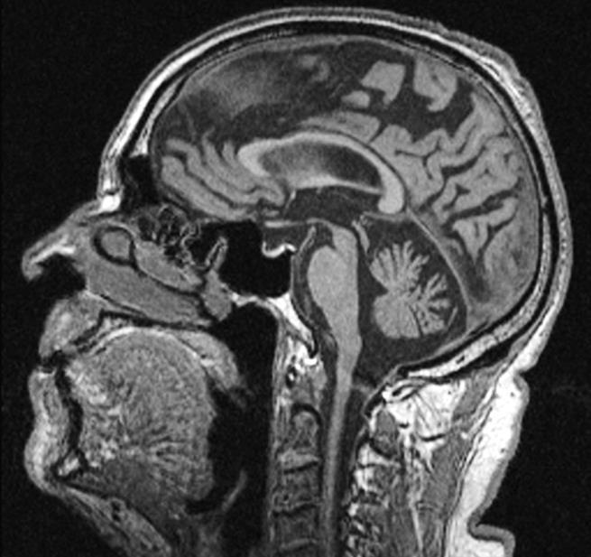 beelden (T1-W) van betrokkene tonen een atrofie van de frontale