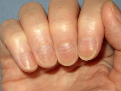 ! Bij koorts (vanaf 38 C) of rillingen moet u contact opnemen met uw arts. Nagelveranderingen Uw nagels kunnen tijdens de behandeling veranderen. Dat gebeurt bij veel mensen.
