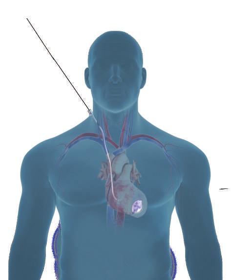 toegang te krijgen tot het litteken op de buitenkant van uw hart om het externe anker te