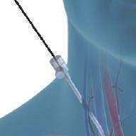 behulp van het Revivent TC via katheter geplaatst ventrikelverbeteringssysteem te bepalen 3.
