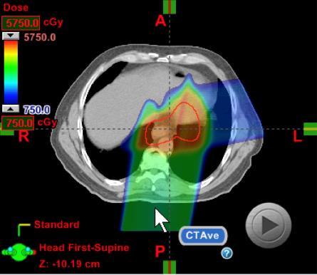 Technology Advances 1980 s 1990 s 2000 s 2005+ 2010+ 3D-CRT X-RAYS IMRT X-RAYS VMAT X-RAYS PASSIVE PROTONS IMPT PROTONS