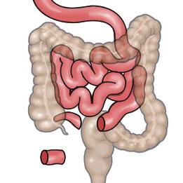 Wat is een Brickerderivatie? Een Brickerderivatie is de meest voorkomende methode om een urostoma te creëren.