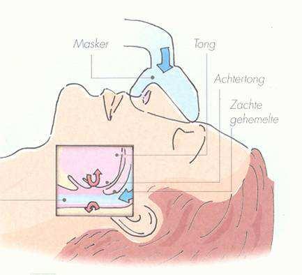 voorkomen dat de keelwand tijdens de ademhaling samenvalt. Hierdoor treden geen ademstilstanden meer op en verdwijnt het snurken.