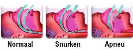 1. Wat is slaapapneu? 2. Wat is CPAP? Voluit spreken we over Continuous Positive Airway Pressure. Door middel van een vaste continue druk worden de bovenste luchtwegen preventief opengehouden.