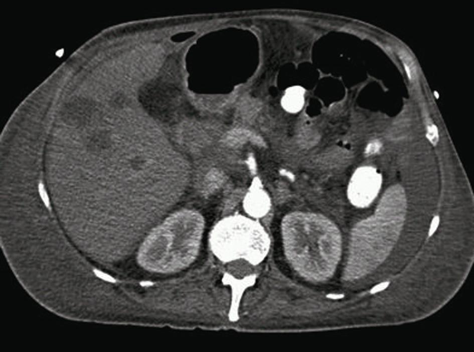 galwegdrainage wordt een pylorussparende pancreaticoduodenectomie verricht. Het pathologisch onderzoek toont een adenocarcinoom van de pancreas; de stagering is T3N1M0.