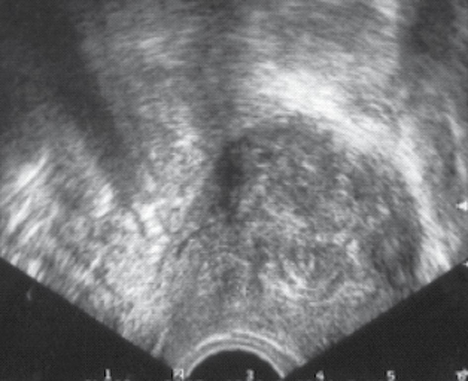 UITLEG KLINISCHE PR AKTIJK Waterecho Inwendig echoscopisch onderzoek waarbij fysiologisch zout in het cavum uteri wordt gebracht, om de binnenkant van de uterus zichtbaar te maken.
