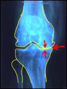 De kraakbeenlaag kan op den duur geheel verdwijnen. Het dunner worden van het kraakbeen zit meestal aan de binnenzijde van het kniegewricht.