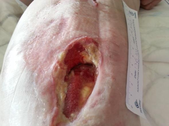 AdvaCyn Wound Care Microcyn Technology Geïnfecteerde Knieprothese 1 maand spoelen maanden