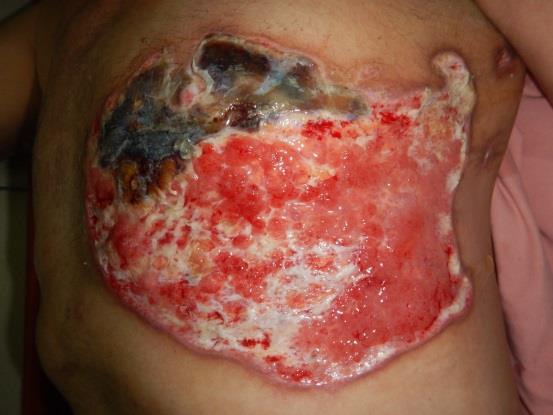 Rhabdomyolisis en gastro-intestinale bloeding.