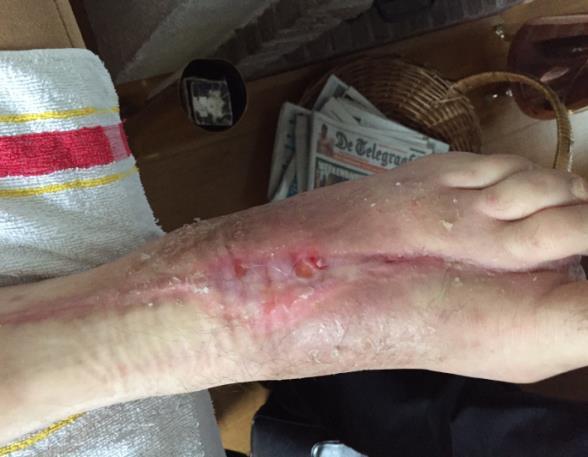 Nanogen Aktigel Traumatische wond linker voet na extirpatie dig 2 Totale duur behandeling: 84 dagen