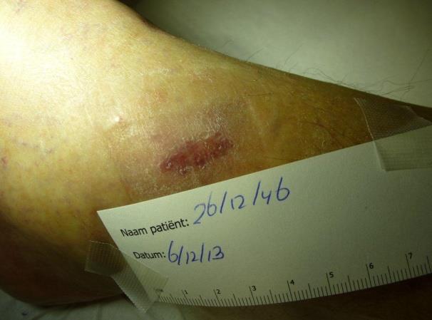 Granulox 6 weken bestaand Ulcus mediale malleolus Totale duur behandeling: 42 dagen Dhr