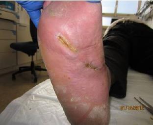 Granulox Diabetisch plantair voetulcera Totale duur behandeling: