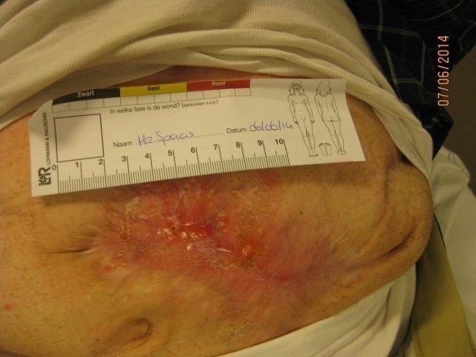 Aldanex Ulcus met periwond maceratie Totale duur behandeling: 13 dagen Man, 77 jaar VG:
