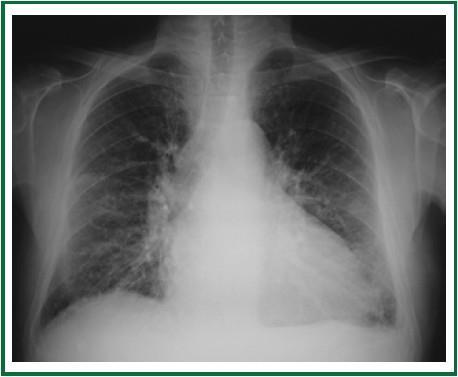 Quizje 1 A: Exacerbatie COPD B: Exacerbatie