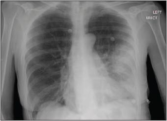 Quizje 3 A: Exacerbatie COPD B: Acuut