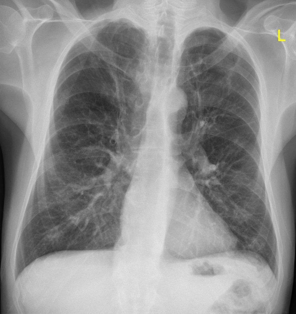 Quizje 4 A: Exacerbatie COPD B: