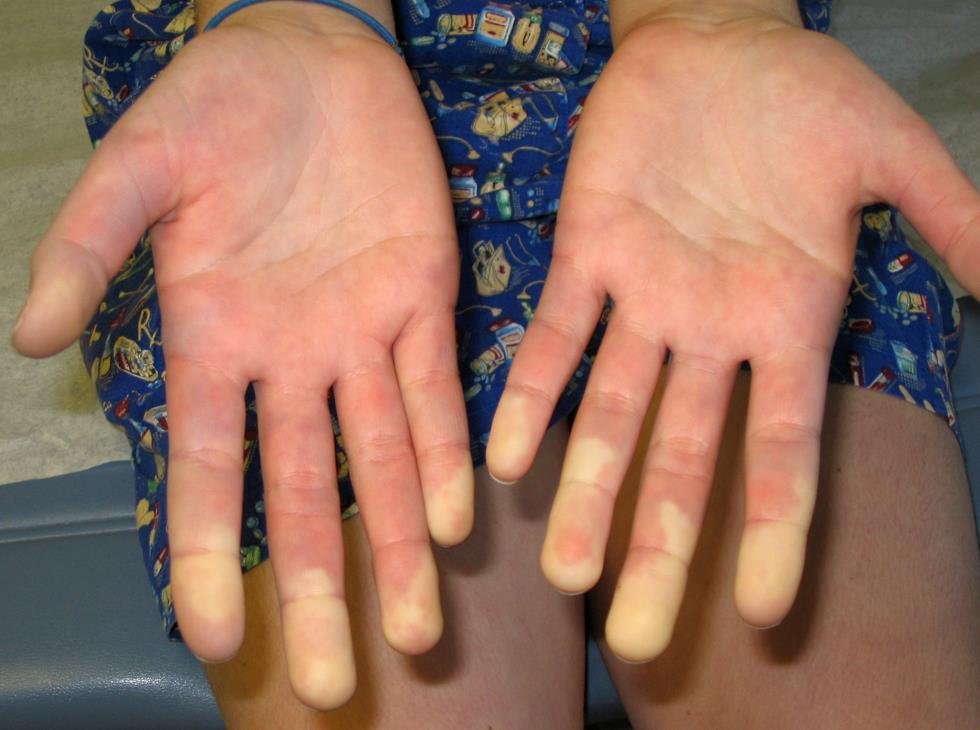 Raynauds