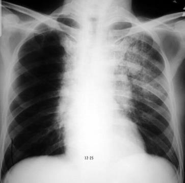 Long toxiciteit Verschillende risico factoren pneumonitis Bronchiolitis